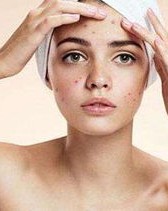 长痘痘该怎么组词