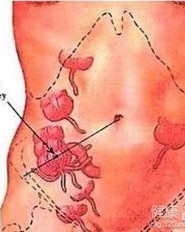 阑尾炎的炎怎么组词