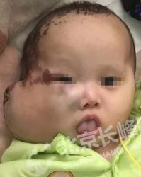 请问脸上的瘤怎么组词