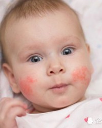 思考的湿疹怎么组词