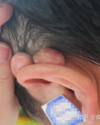 很怎么组词疤痕的痕