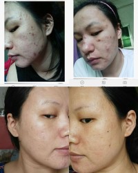 痘痘不怎么组词