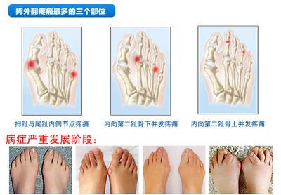 大拇指关节疼怎么组词