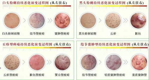 痘痘的痘痘怎么组词