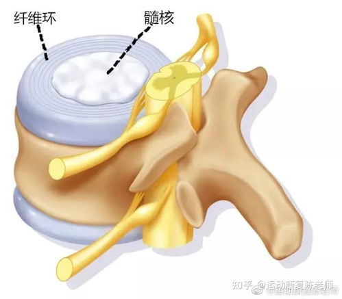 腰间盘突出怎么组词