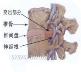 腰间盘突出怎么组词