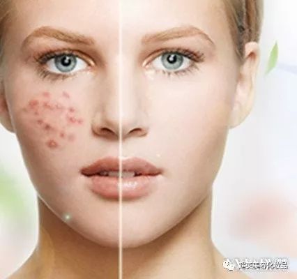 痘战痘痘怎么组词