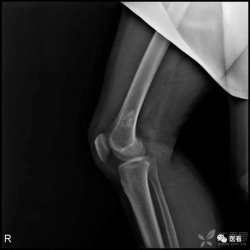 股骨骨头的骨怎么组词 股骨骨头的骨怎么组词