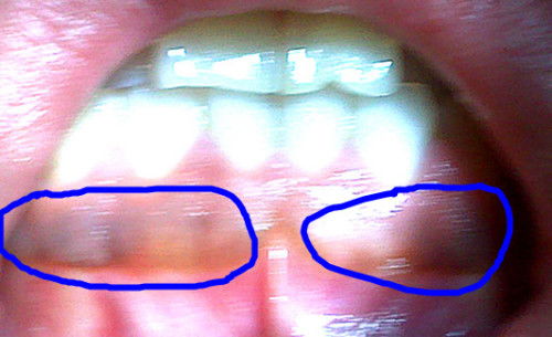 牙龈怎么组词 牙龈怎么组词