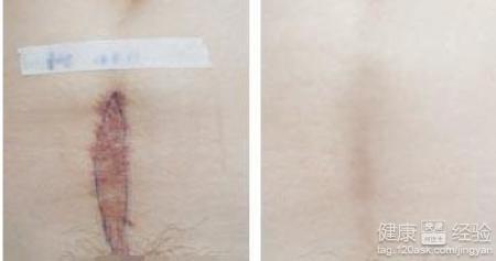 伤痕的痕怎么组词疤痕 伤痕的痕怎么组词疤痕