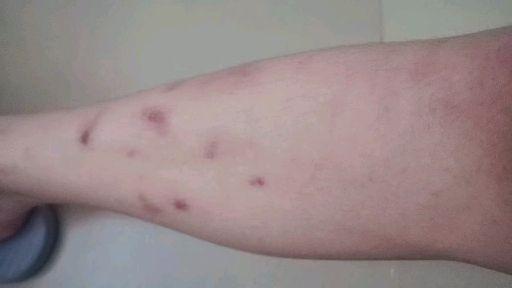 伤痕的痕怎么组词疤痕 伤痕的痕怎么组词疤痕