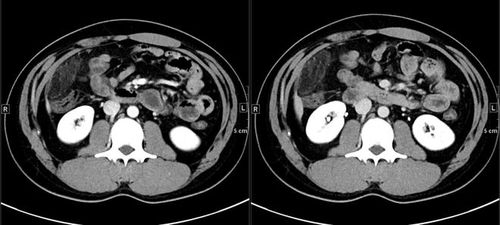 阑尾炎的阑怎么组词