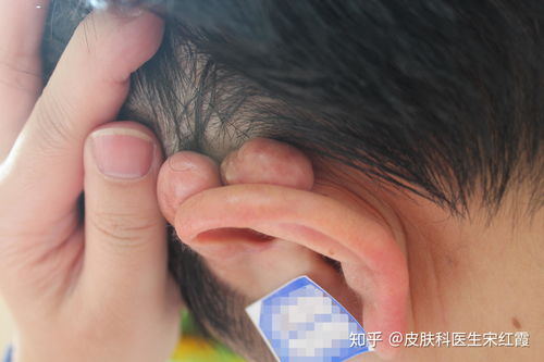 很怎么组词疤痕的痕