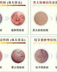 痘痘的痘痘怎么组词