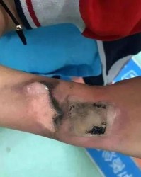 手被烫伤了可以怎么组词